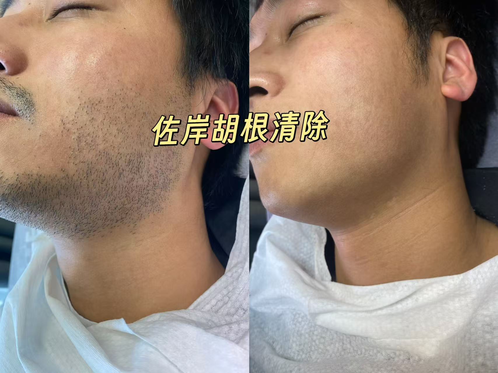 温州脱胡子